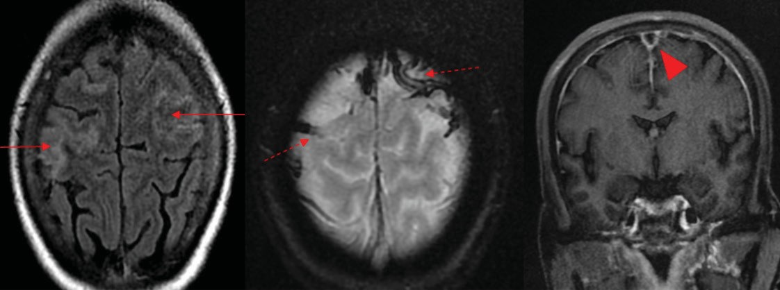 Cisplatin induced cerebral sinus venous thrombosis in cervical cancer patients treated with concurrent chemoradiation: a case series